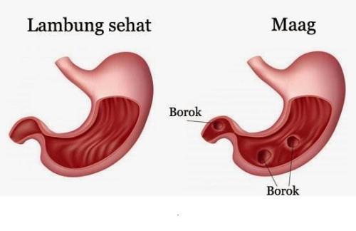 5 Gejala Terkena Penyakit Maag Akut Mudation Com